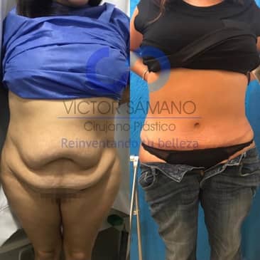 Slider image (6) Cancun Plastic Surgery Center by Dr. Víctor Sámano